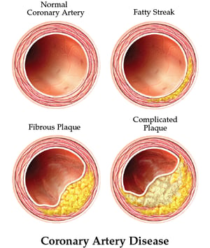 CoronaryArteryDisease-6.20.18